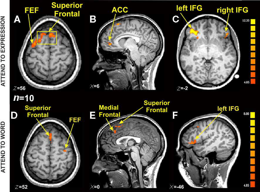 Contains 6 images of fMRI scans of the brain from differing orientations. The first three images display the brain’s response to expressions, while the lower three illustrate the brain’s response to words. A coloured scale on the side from red to yellow can be used to qualitatively assess the strength of the brain’s response, in addition to the location of brain activity.